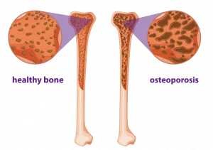 osteoporosis symptoms