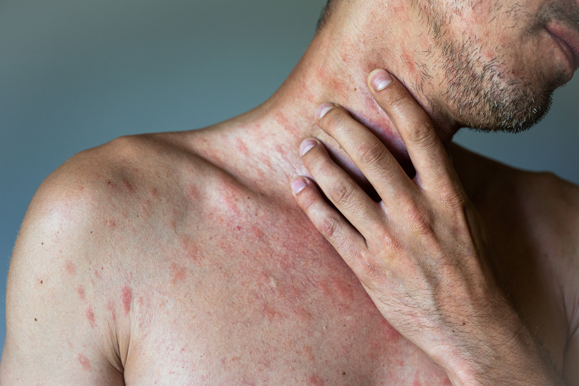 Hives On Skin: Symptoms, Causes, and Treatment