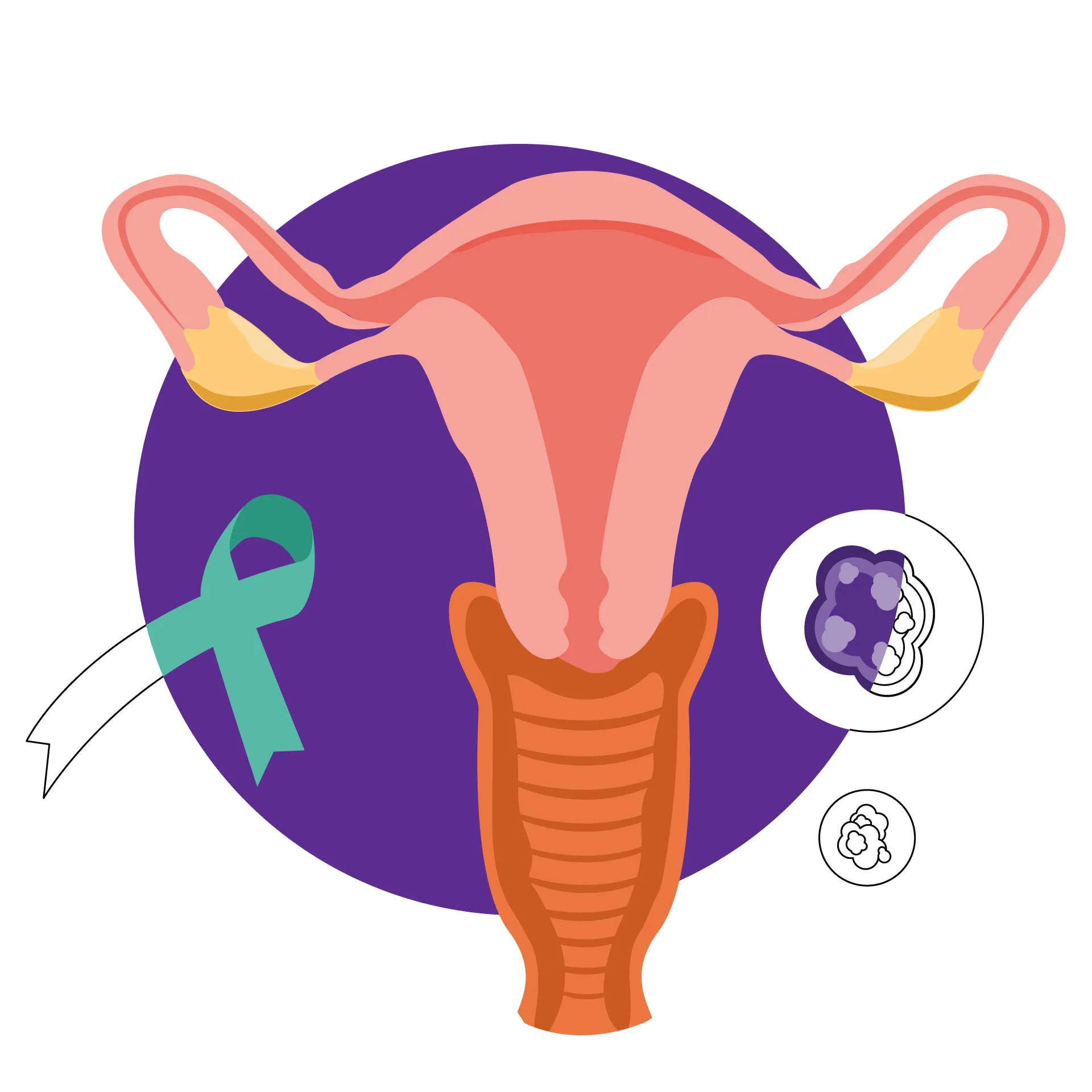 Cervical Cancer - 6