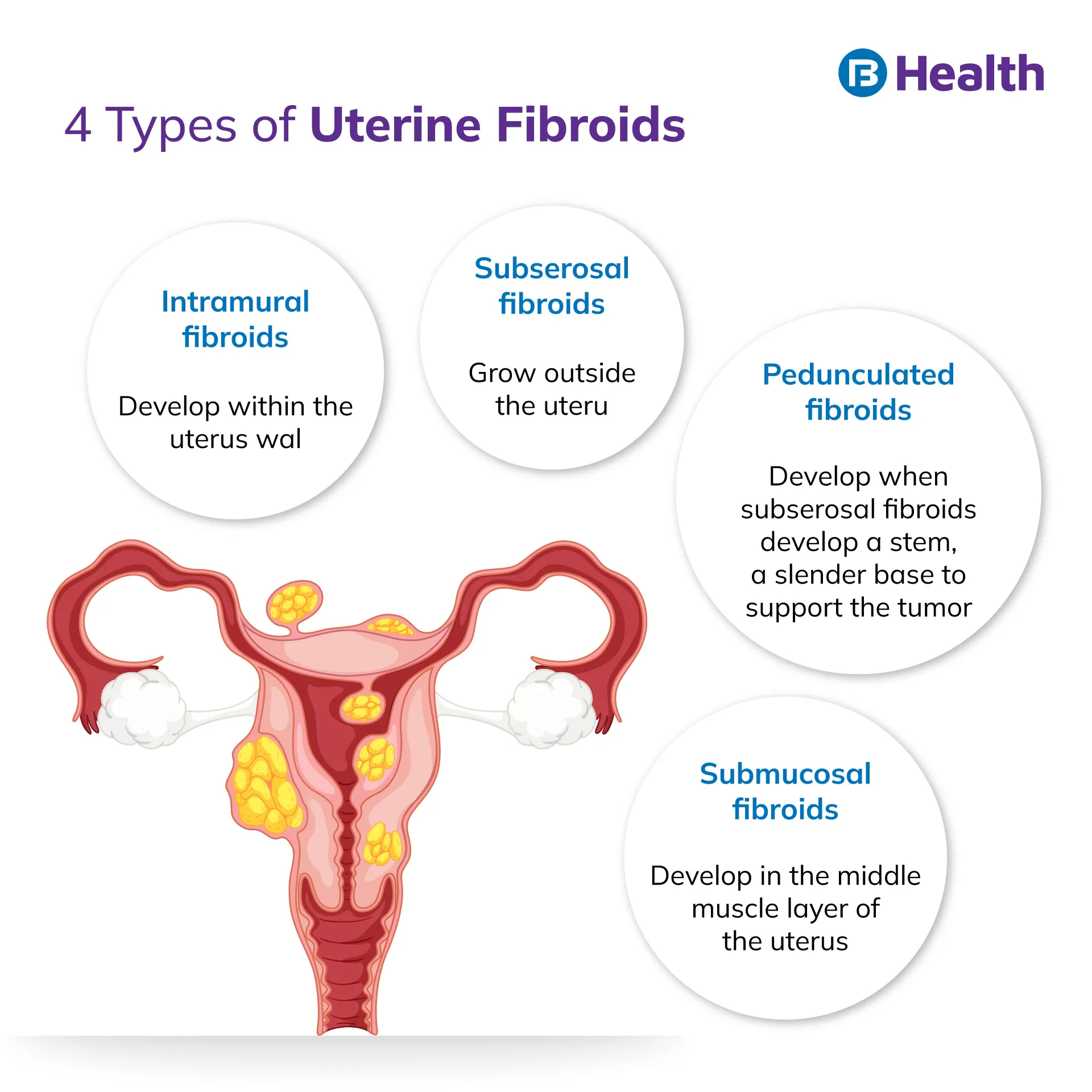 Uterine fibroids types