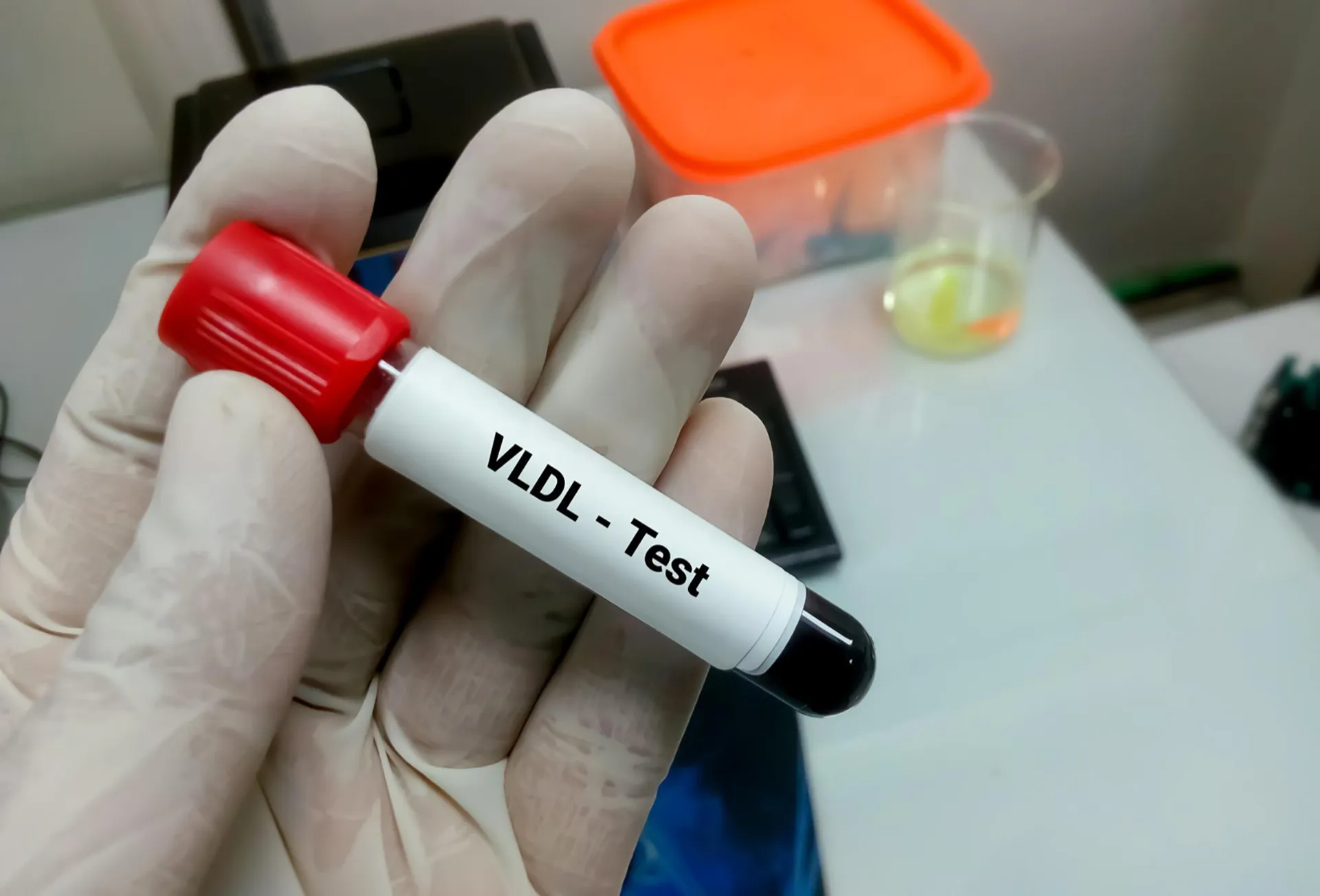 VLDL cholesterol blood test