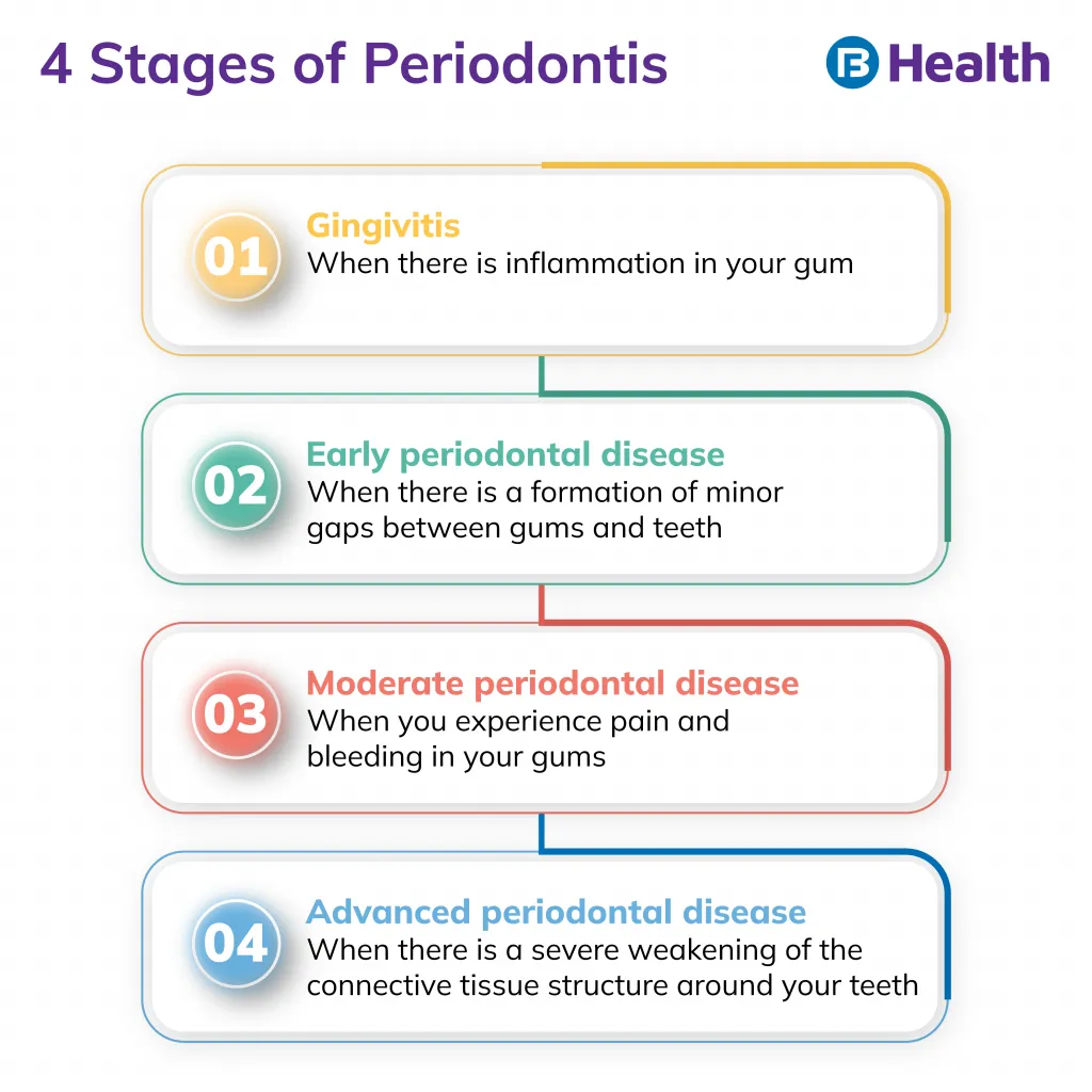 Periodontitis stages