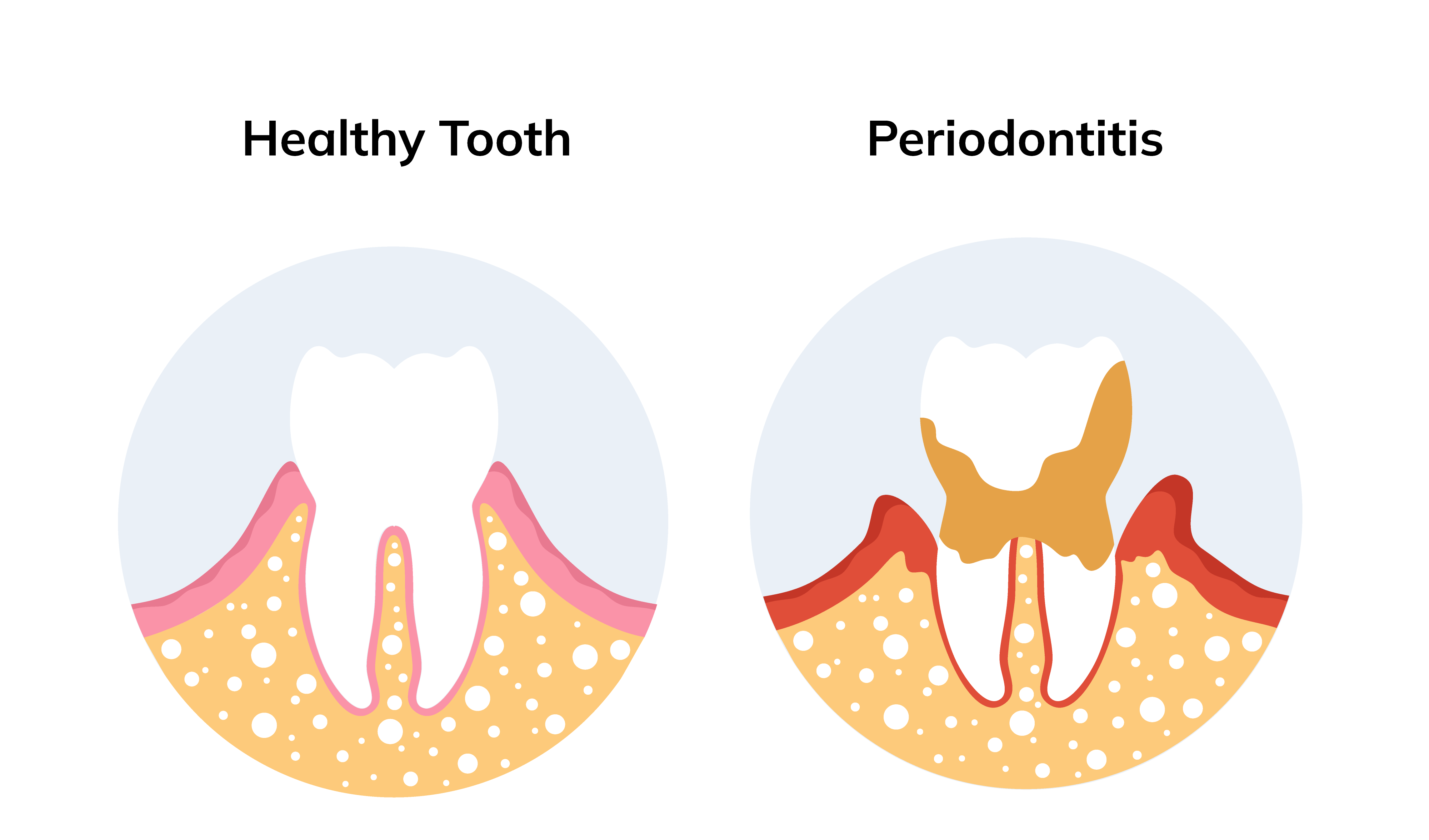 Periodontitis: Causes, Symptoms, Stages and Treatment