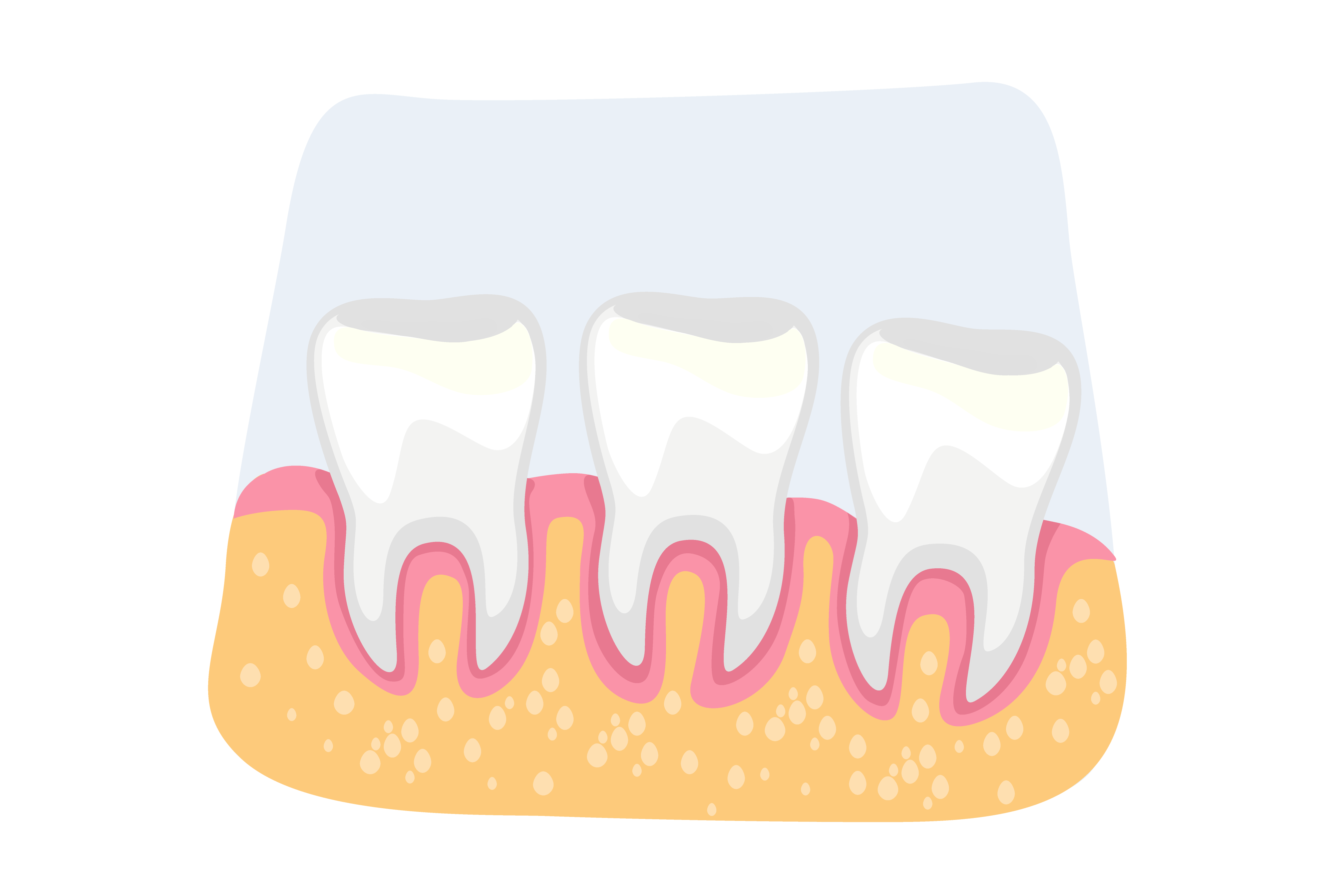 Periodontitis: Causes, Symptoms, Stages and Treatment