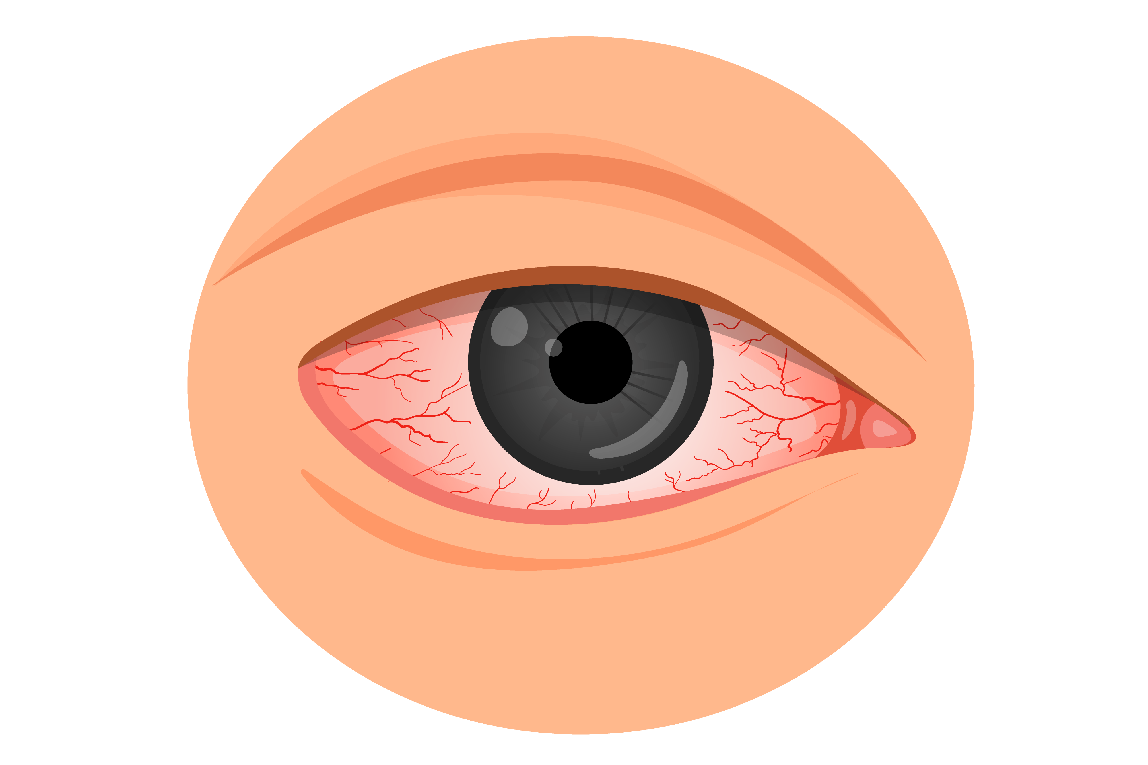 Red Eyes: Causes, Symptoms, Complications & Prevention Tips