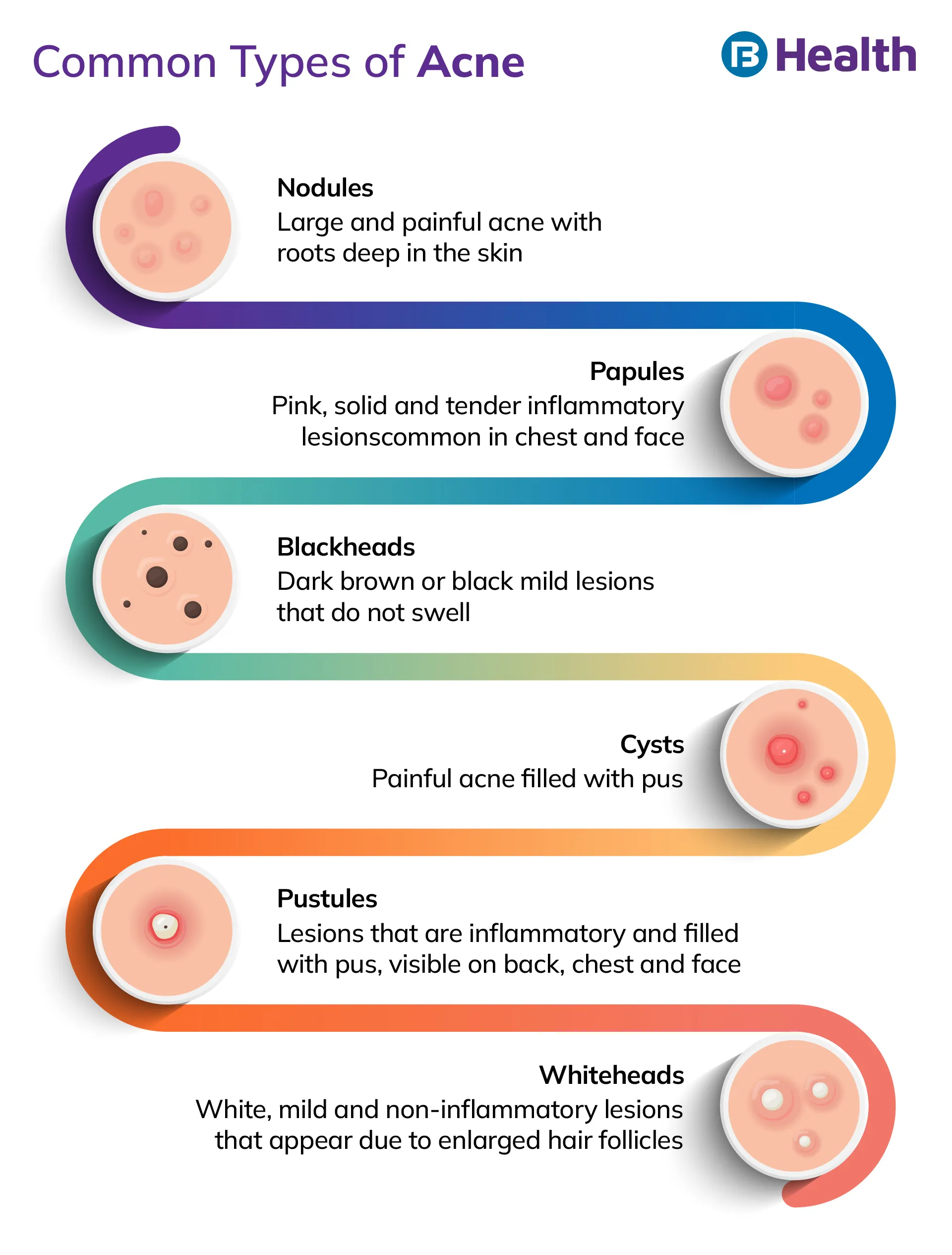 types of acne