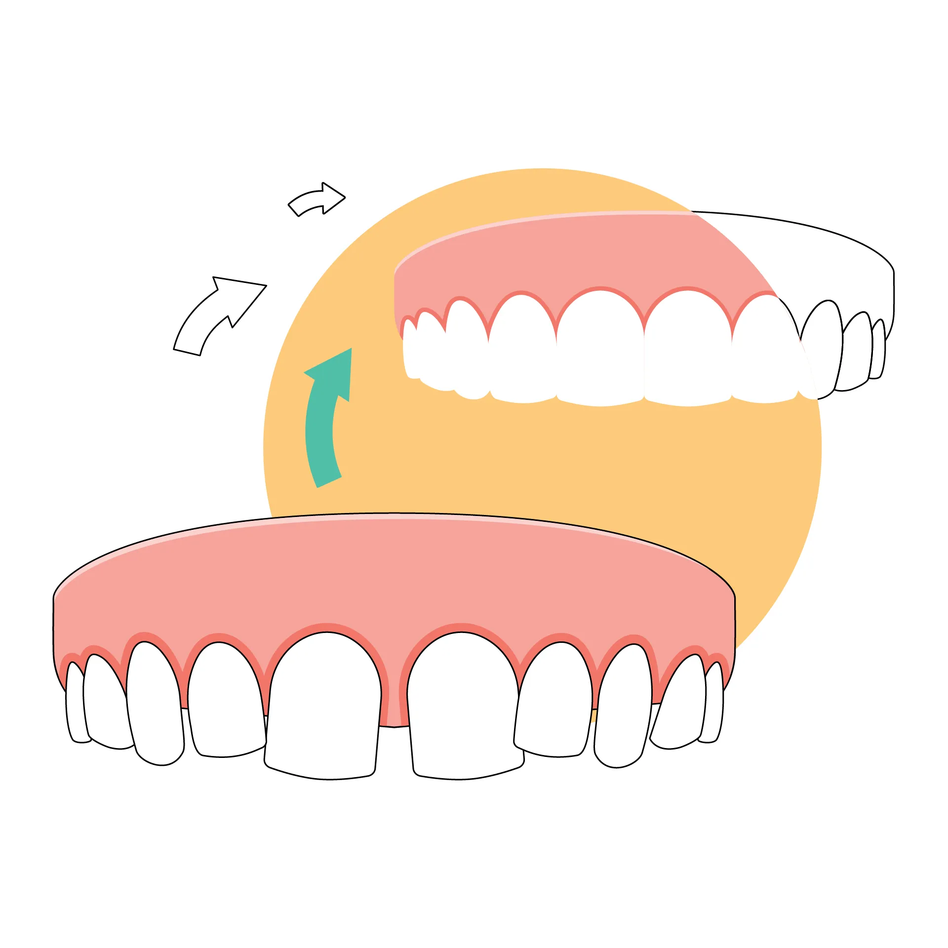 Diastema