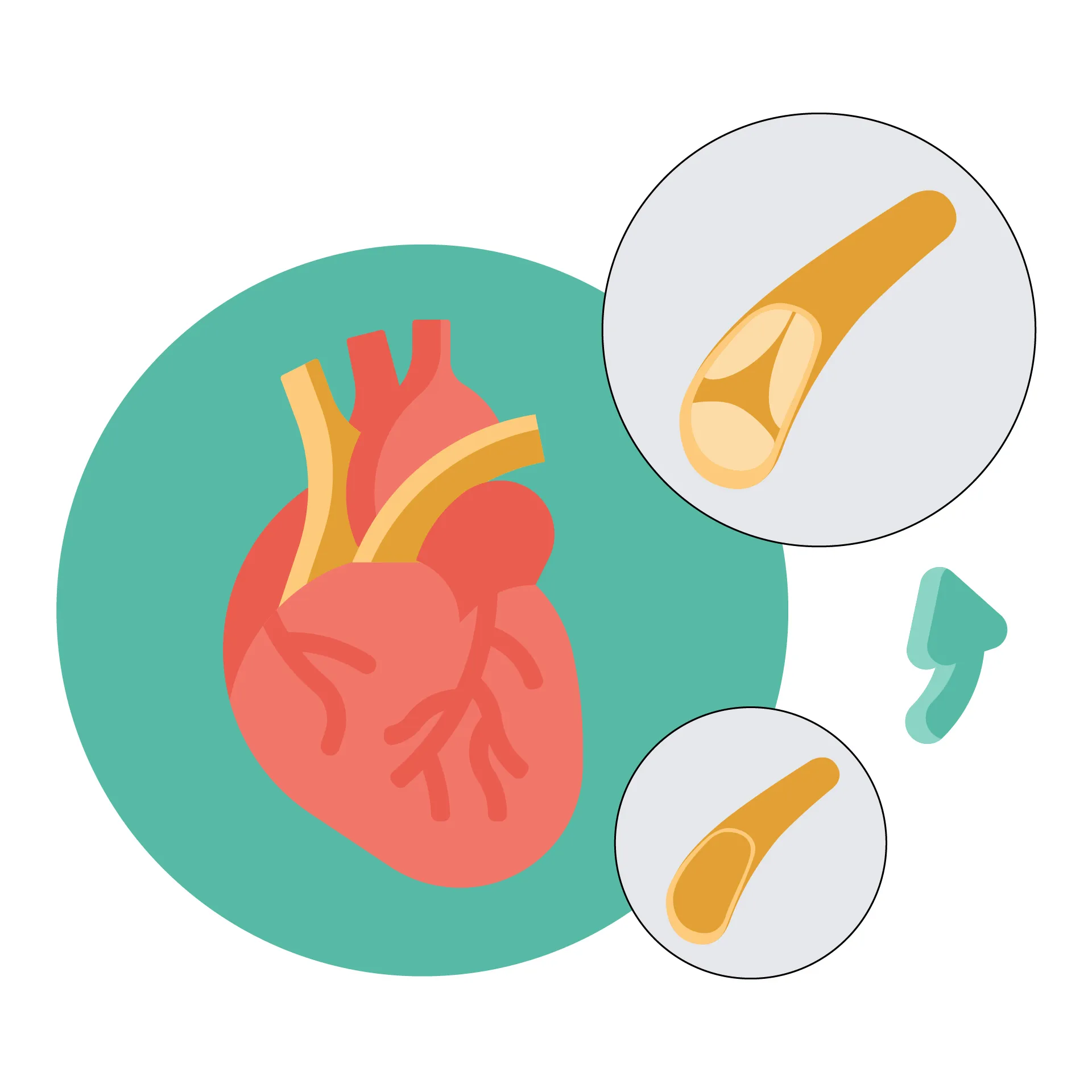 Pulmonary stenosis