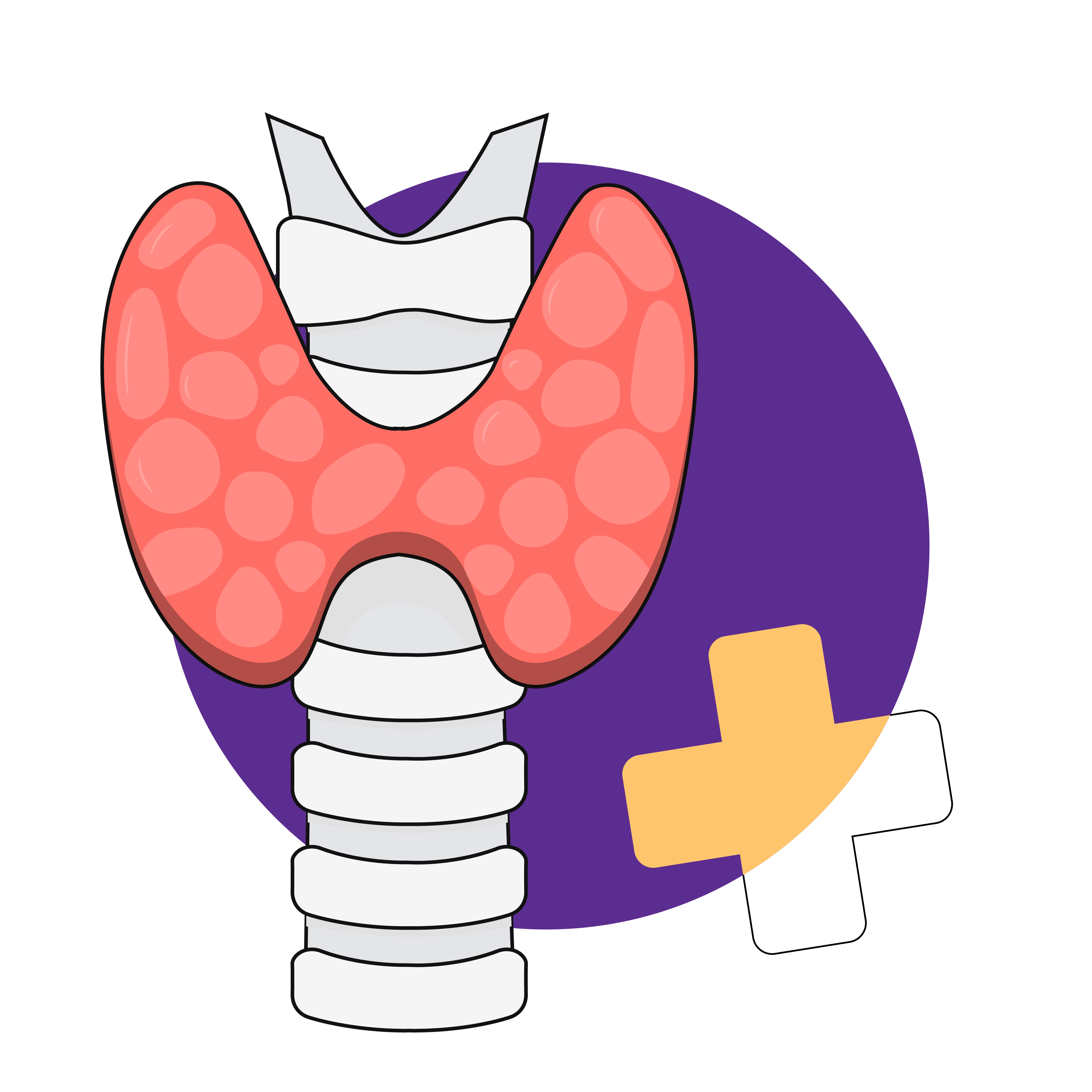 Subacute Thyroiditis