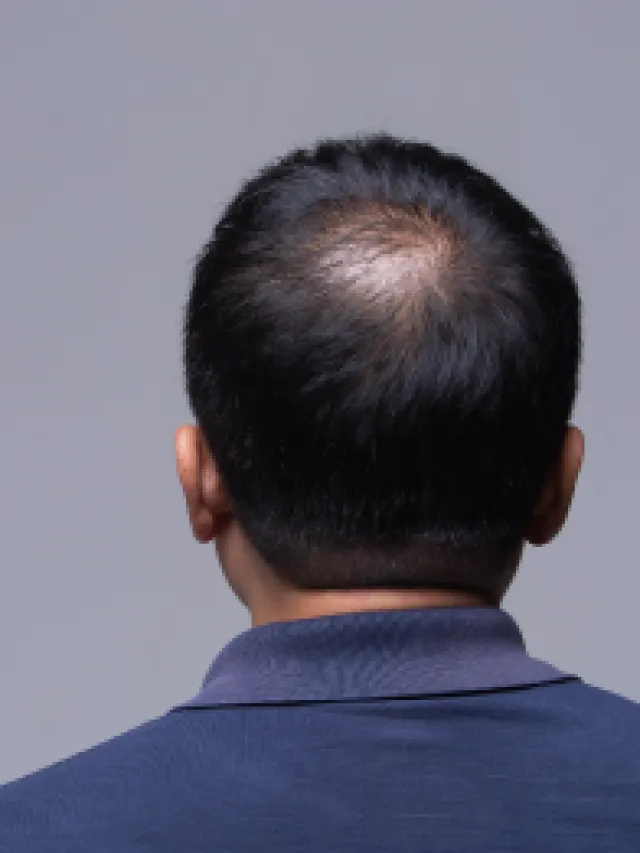 Battle Balding