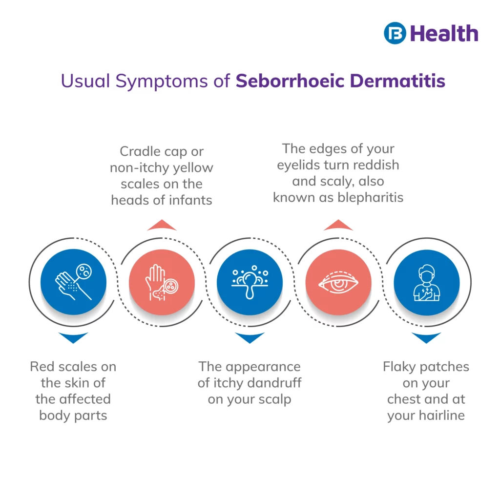 2--feb ig-Seborrhoeic Dermatitis
