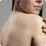 Back Acne: Causes, Symptoms, Treatment, Types, Prevention