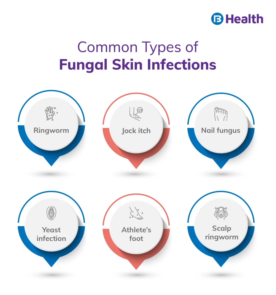 Types of Fungal Rash Infographic
